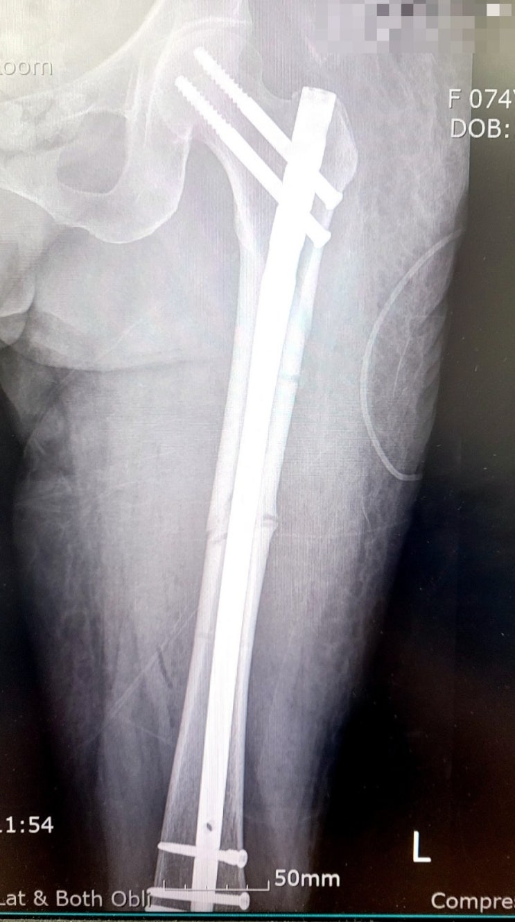 OS) femur shaft Fx. : FRN (Femoral Recon Nail System) : 네이버 블로그