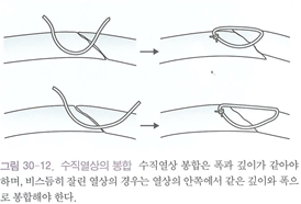 각막 외상 - 각막 열상(Corneal laceration) ② : 네이버 블로그