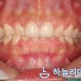 인천서구청라치아미백, 변색된 상악 전치부 치아의 지르코니아크라운 수복 증례(전문가 치아미백)