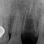 치아 외상, 치아 탈구 시 치료