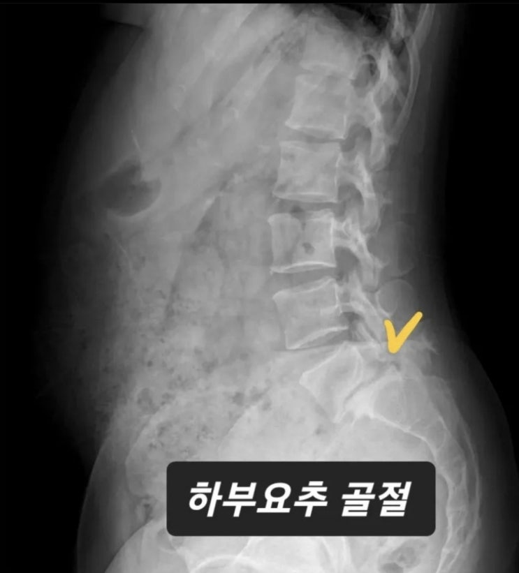 [네이처운동센터] 하부요추 골절 : 네이버 블로그
