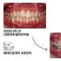 나비 모양 치아교정 잘하는 곳 : 데이몬 클리어, 발치 교정치료 살펴보기