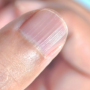 손톱 세로줄 원인 색깔별 증상 및 해결방법은 무엇일까?(손톱이 이상해요)