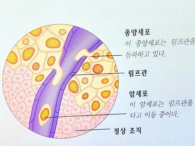위암 초기증상 생존율 위암에좋은음식 3가지 짠음식 탄음식 과음 흡연 주의해야 : 네이버 블로그