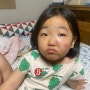 5세 아이 모기 알레르기 (스키터 증후군)