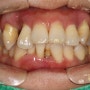 영등포치과 치주 질환 치아교정과 임플란트