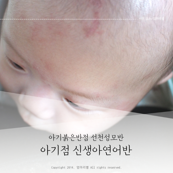 아기점 아기붉은반점 화염상모반 신생아연어반 선천성모반 : 네이버 블로그