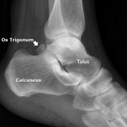 [OS trigonum] Os trigonum syndrome, Posterior ankle impingement syndrome