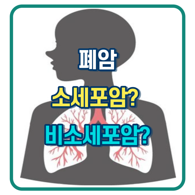 폐암 비소세포암 소세포암 확장병기? : 네이버 블로그
