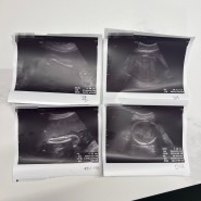 임신 31주 - 33주 : 백일해 주사 및 막달 검사