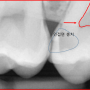 치아사이 충치, 인접면 충치 어떻게 발견하고 치료하나요?