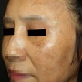 기미, 흑자를 동반한 50대 여성 후천성 오타모반(오타반점) 치료 사례 ::: 부천 더 피부과