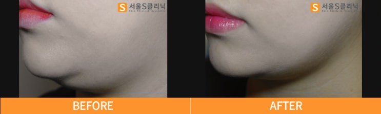 2주 만에 얼굴살 빼기 딱 2가지만 기억하세요 : 네이버 블로그 2주 만에 얼굴살 빼기 딱 2가지만 기억하세요 : 네이버 블로그