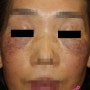 후천성 오타모반, 오타모양반점(ABNOM) 레이저치료 증례 ▒ 부천 더 피부과 특화진료 ▒