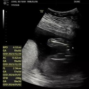 임신일기 #28, 동국대 일산병원 임신 18주1일 / 기형아 검사결과,아기체중 246g