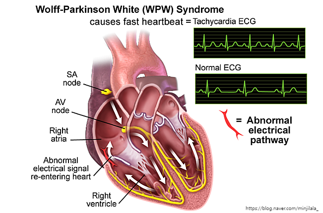 WPW증후군 심실조기흥분증후군 wpw syndrome wolff parkinson white syndrome 심전도 원인 증상 ...