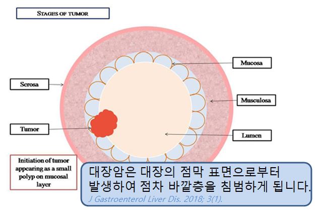대장암 1기, 2기, 3기, 4기 분류에 대해 알아봐요 : 네이버 블로그