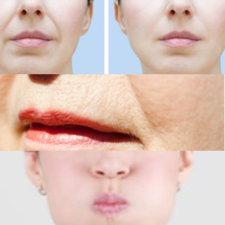 깊은 팔자주름 없애기 운동 및 입가주름 이마잔주름 주름스틱 추천 : 네이버 블로그