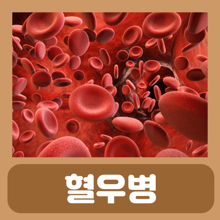 상처 지혈 방법 하는법 혈우병 혈액응고장애 피가 안멈춰요 : 네이버 블로그