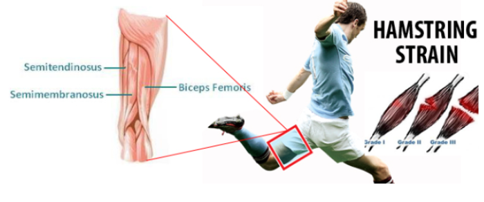 [방배동PT, 방배역PT] 햄스트링근 염좌(Hamstring Muscle Strains) : 네이버 블로그