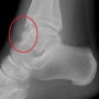발목 전방 충돌증후군 - 발목 앞 통증, 발등통증 / 한방치료