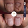 nailbiting ∽ onicofagia ∽ nailfungus = nail care treatment / LAON NAIL CLINIC