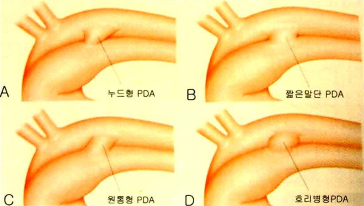 Coil 색전술을 이용한 PDA 교정 : 네이버 블로그