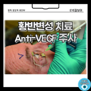 황반변성 치료 : Anti-VEGF 눈 주사(안구 주사) 종류, 효과