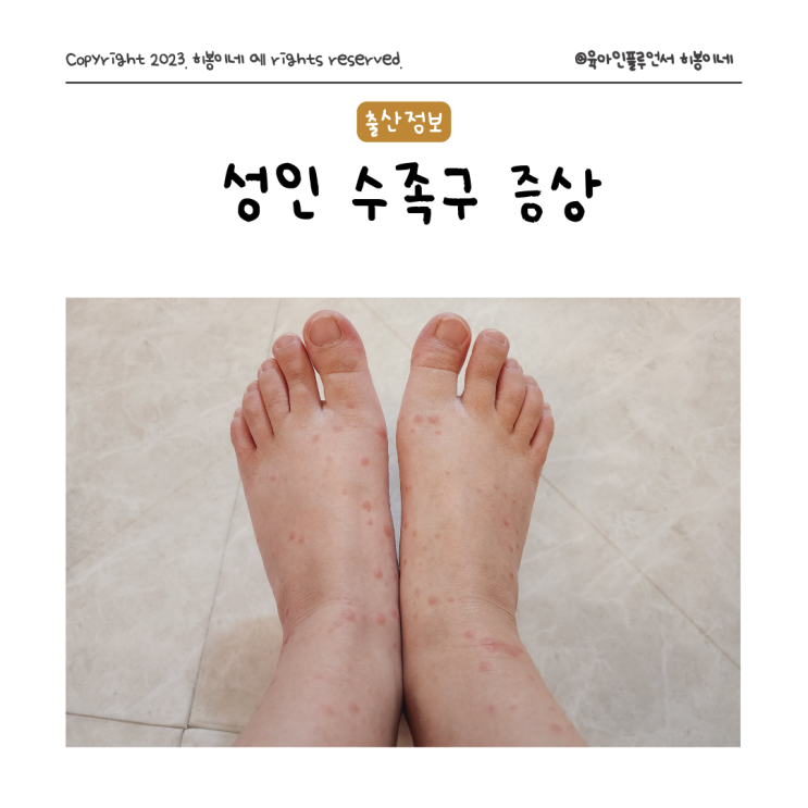 성인 수족구 증상 격리 수포 기록 어른 수족구 전염 경험담 : 네이버 블로그