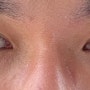 신사역 루비성형외과-남자눈성형 비절개눈매교정 쌍수 이미지변신! (+무쌍,속쌍)