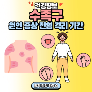 수족구 원인, 증상, 진단, 검사, 치료, 예방, 전염, 잠복기, 수포, 입안, 열, 구내염, 격리 기간