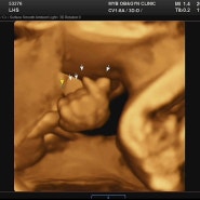 임신기록: 태동의 변화 및 입체초음파 (임신중기 25-28주)