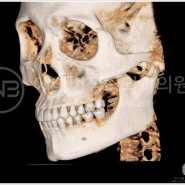 [AB소개] 에이비성형외과 안면윤곽 어떻게?