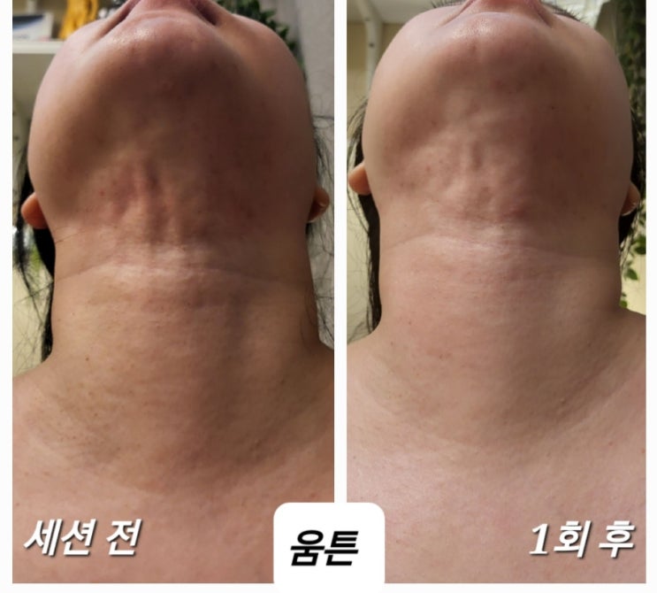 이중턱 지흡 후 목 세로주름 흉살, 턱밑 유착과 깊어진 마리오네트 주름, 자갈턱 : 네이버 블로그