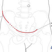 Modified stoppa approach