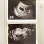 리오라여성의원 시험관 1차 - 8. 아기집, 난황 확인 그리고 임신확인서 발급