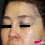성인 중증형 선천성 오타모반 치료 사례 - 눈꺼풀 병변 저색소침착 부작용없이 치료하는 피부과