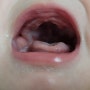 10개월 아기 수족구 구내염 증상 치료 격리기간 어린이집 확인서 분유 이유식 거부 극복