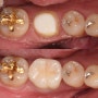 이수역치과 치아 크랙은 (cracked tooth), 무조건적인 발치전에 신경치료부터! 더강한치과