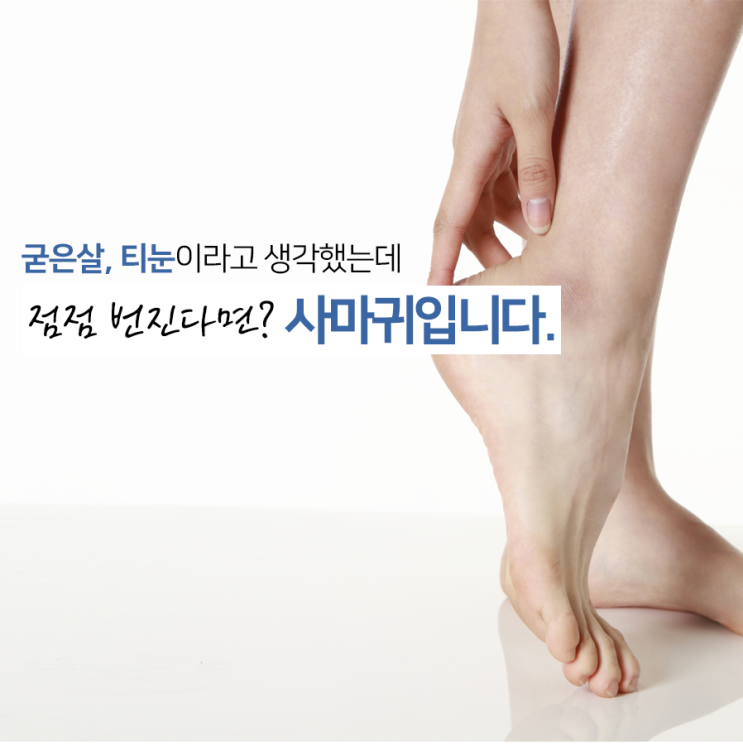 발 사마귀 제거, 초기에 잡아야 합니다! : 네이버 블로그