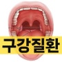 구내염(입안염증, 혀염증) 쇼그렌증후군 증상 원인 및 한의원 치료 / 구강건조증 혀갈라짐 구강작열감증후군 혀통증