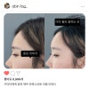 이마필러 후기(가격, 붓기, 아바타) 종로피부과 2차 방문 : 네이버 블로그 이마필러 후기(가격, 붓기, 아바타) 종로피부과 2차 방문 : 네이버 블로그