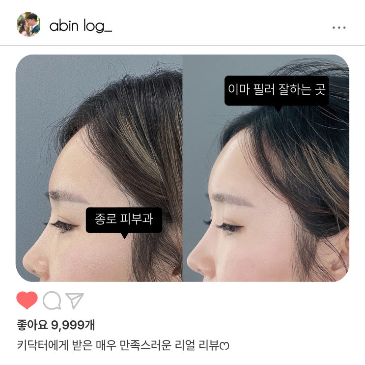 이마필러 후기(가격, 붓기, 아바타) 종로피부과 2차 방문 : 네이버 블로그