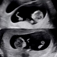 [임신 일기12] 무기력함과 우울함의 끝을 달리는 쌍둥이 임신 9주차-11주차 증상