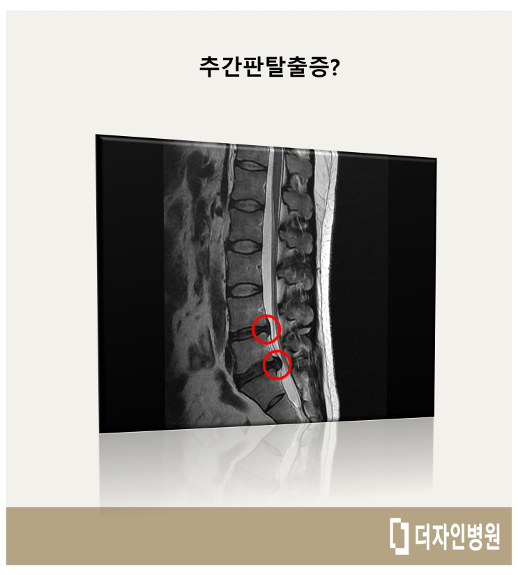 추간판 탈출증 : 네이버 블로그