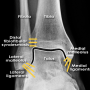 경비 인대결합 손상 - 발목염좌, 발목통증, 발목 불안정성, 비골골절Weber Classification