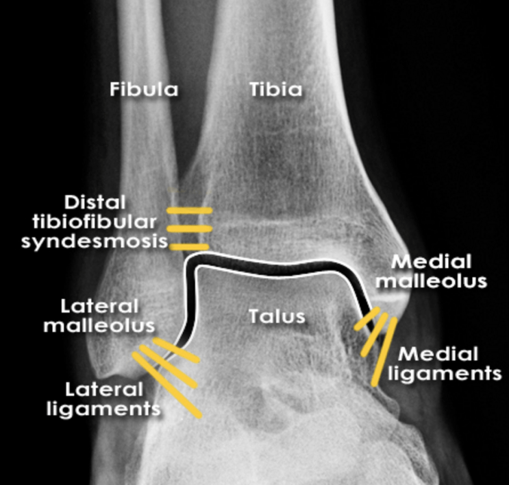 경비 인대결합 손상 - 발목염좌, 발목통증, 발목 불안정성, 비골골절Weber Classification : 네이버 블로그