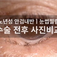 노년성 안검내반ㅣ수술 전후 사진 비교