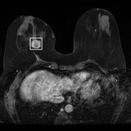 데이터 어노테이션 리뷰: 유방암 MRI 영상분할(Segmentation)