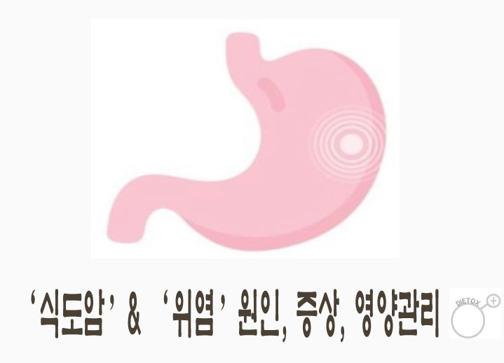 급성 위염과 만성 위염의 원인, 증상, 영양관리 : 네이버 블로그